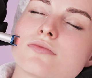 Tratare venectazii vase sparte cu Laser Pulsat PERFECTA la DermaLife